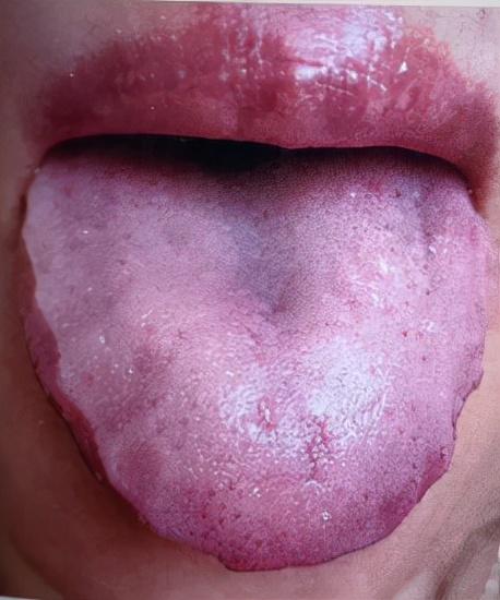 舌頭紅潤有齒印屬于什麼虛（舌診分析舌頭發紫）1