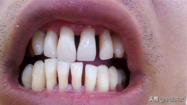 牙與牙之間有肉突出（為什麼說腎絕牙齒長）2