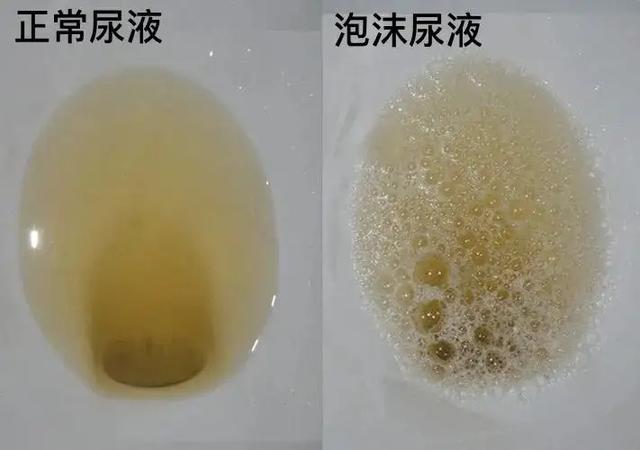 尿液有泡沫是腎有問題嗎（尿中有很多泡沫是什麼原因）2