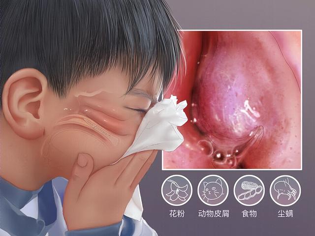 過敏性鼻炎八大常見問題早知道（關于過敏性鼻炎的相關問答）2