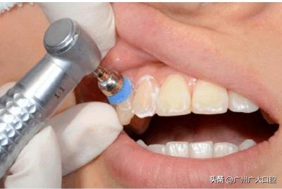 牙齒美白方法的優缺點（牙齒美白有多少種方式）8