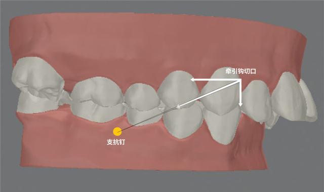 正畸隐形牙套皮筋挂法（隐形矯治中力的施加控制與皮筋運用）2