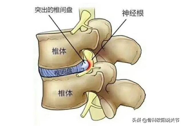 腰肌勞損腰背疼痛是什麼原因（怎麼區分腰肌勞損還是腰椎間盤突出）3