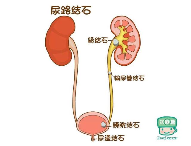 腎結石在吃的方面應該注意什麼（傷不起的腎結石）1