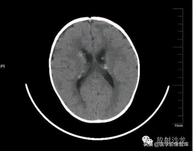 顱腦先天畸形的概率（顱腦先天畸形CT診斷）8