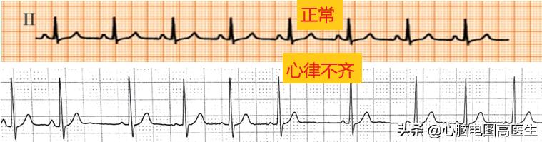 心電監護上的心電圖怎麼看圖解（心電圖怎麼看心電圖入門講解五）3