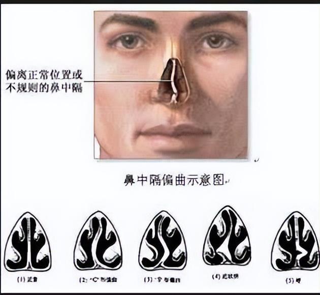 鼻中隔彎曲需要整形手術嗎（鼻整形中可以矯正鼻中隔偏曲嗎）1