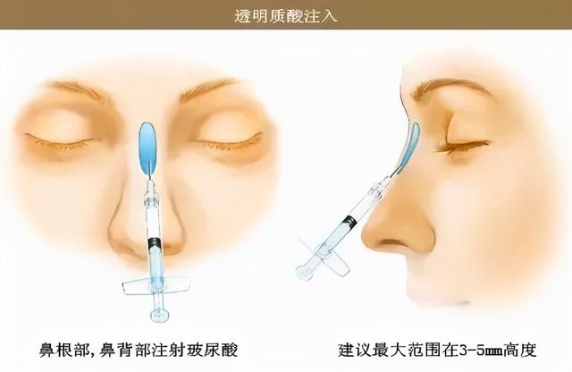 各種隆鼻材料的區别（不同的隆鼻材料應該如何選擇）2