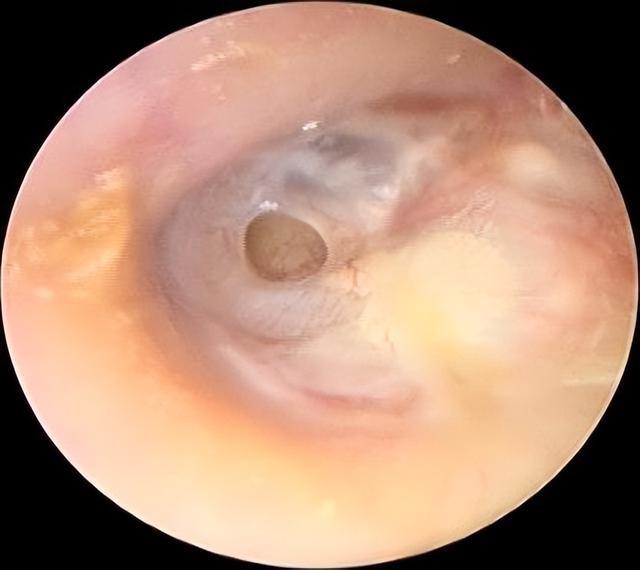 鼓膜穿孔手術後4個月耳鳴（聽力下降伴耳鳴）2
