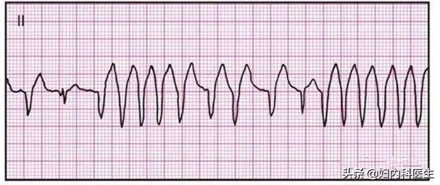 典型的心電圖圖譜（就診常見的心電圖）3
