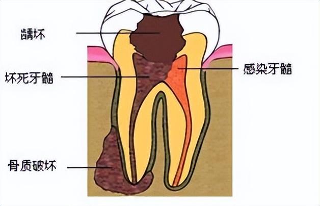 牙痛蛀牙怎麼治療（牙痛不一定是蛀牙）3
