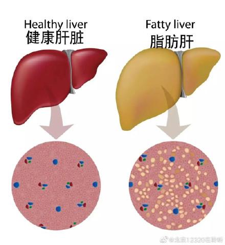 脂肪肝屬于主要疾病嗎