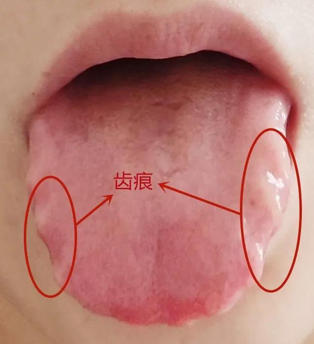 如何查出肝上陰影（舌上有痕小心是）1
