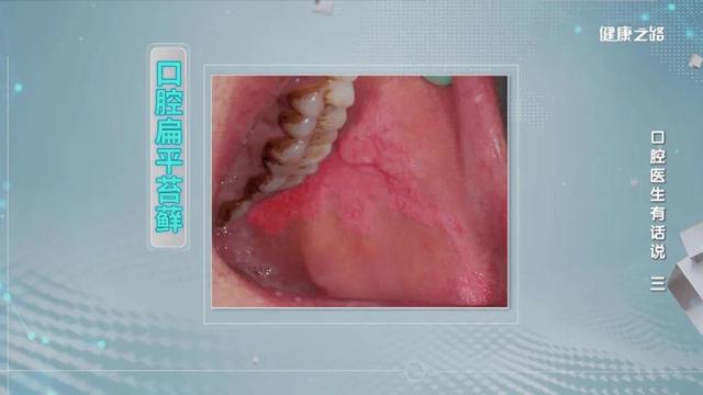 口腔粘膜癌會出現哪些症狀（口腔黏膜發生這些變化）2