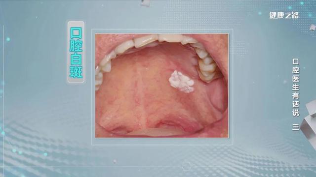 口腔粘膜癌會出現哪些症狀（口腔黏膜發生這些變化）3