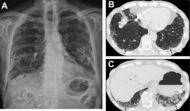 職業性肺病及其他呼吸道疾病（職業性肺病的分類及其影像學表現）(6)