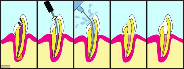 牙齒根管治療了一年後又痛（根管治療的四個步驟）3