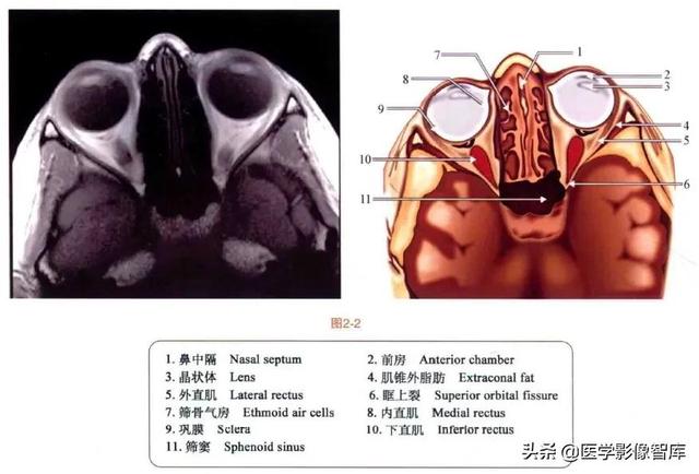 ct與mri斷層解剖學袖珍圖譜電子版（眼眶MRI斷層解剖速查圖譜）3